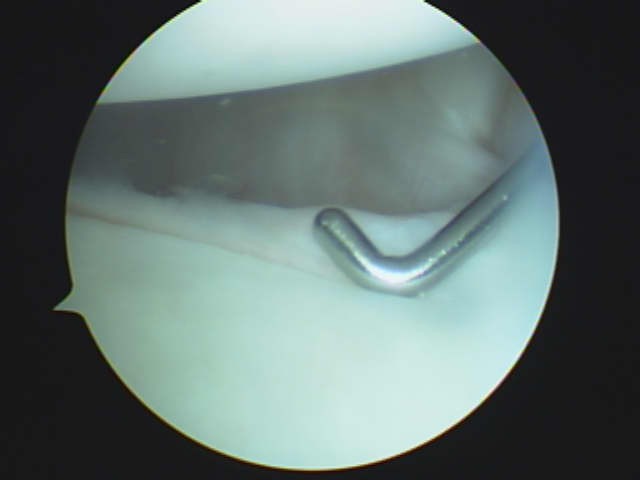 Superior labral tear, or SLAP tear